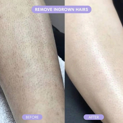 Nurelia® Hair Removal Moisse
