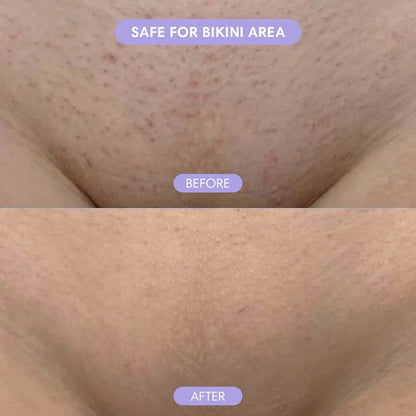 Nurelia® Hair Removal Moisse